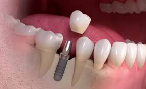 A Fake Teeth With Dental Implants